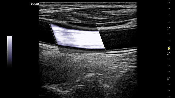 GE Logiq P6 Ultrasound