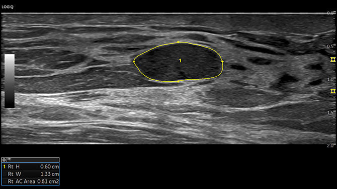 GE Logiq P6 Ultrasound