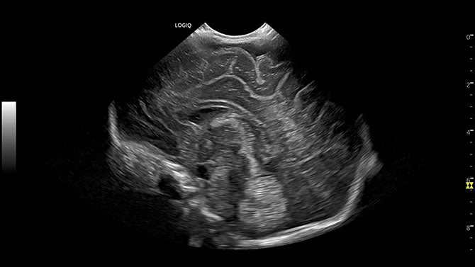 GE Logiq P6 Ultrasound