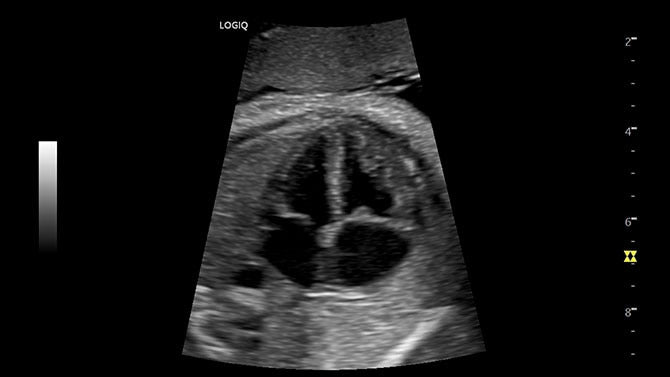 GE Logiq P6 Ultrasound