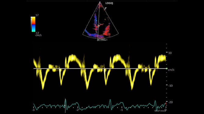 GE Logiq P6 Ultrasound